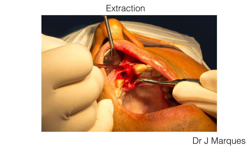 implantologie extraction