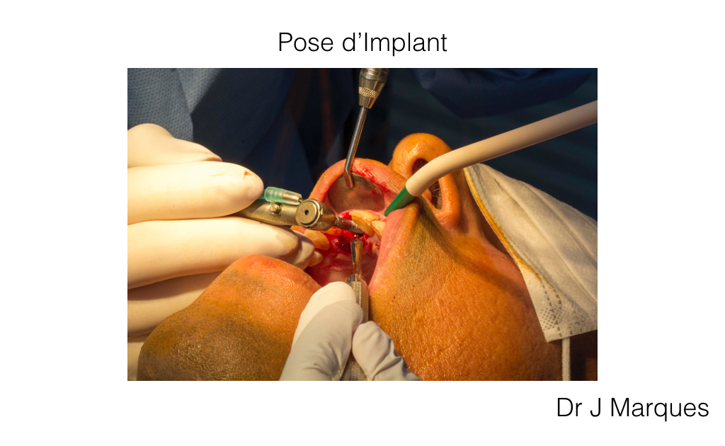 implantologie pose